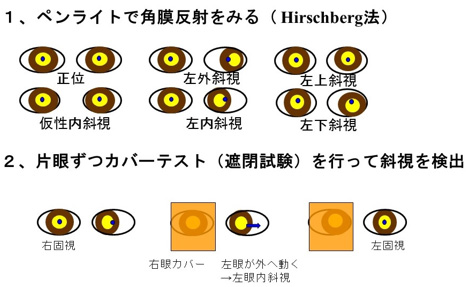 図１：眼位検査（斜視の検出）