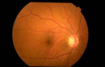 図１正常網膜写真（右眼）
