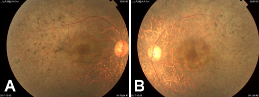 図2 網膜色素変性症写真。A：右眼、B：左眼