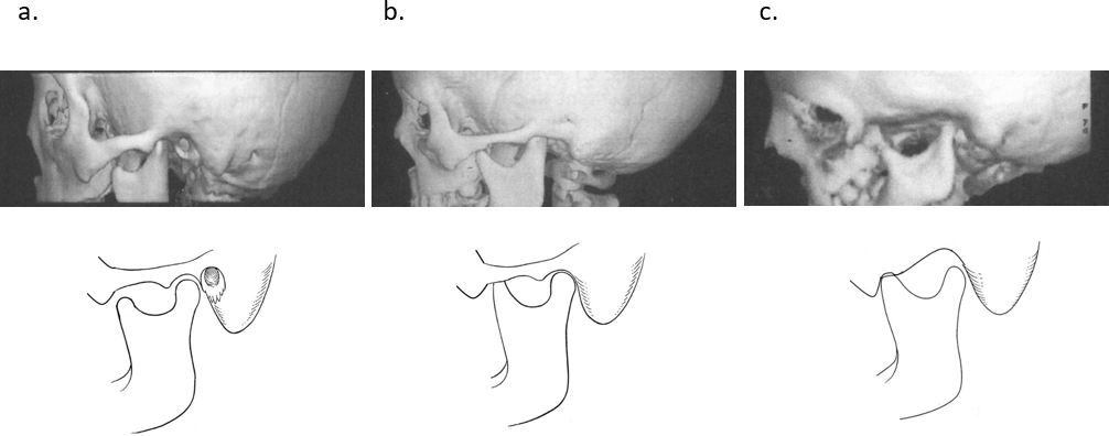 外耳道閉鎖症における下顎頭の位置